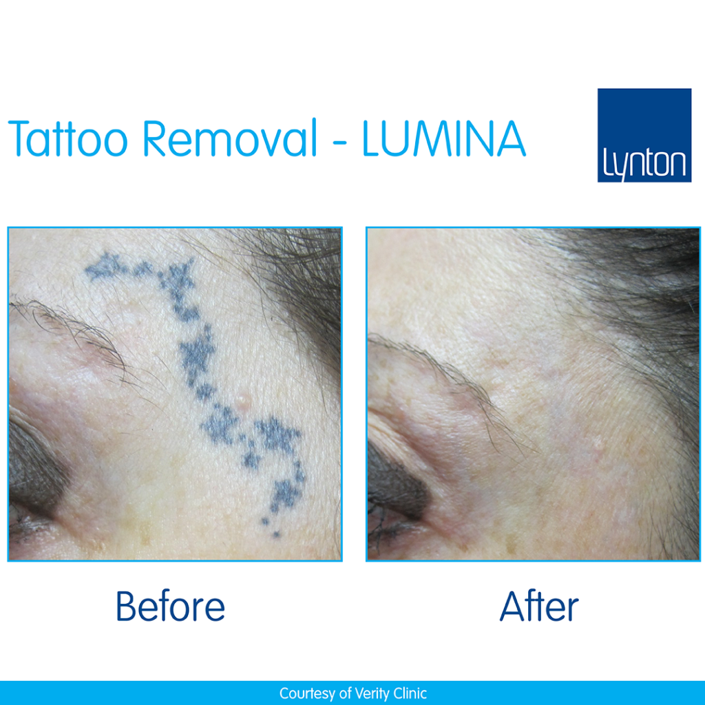 Lynton LUMINA® – Professional Laser and IPL Device - House of Camille